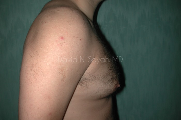 Male Breast Surgery Before and After | Sayah Institute