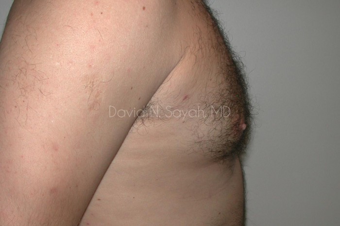 Male Breast Surgery Before and After | Sayah Institute
