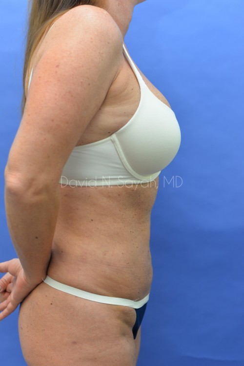 Mini Tummy Tuck Before and After | Sayah Institute