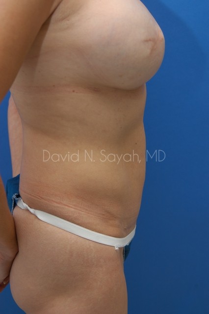 Mini Tummy Tuck Before and After | Sayah Institute