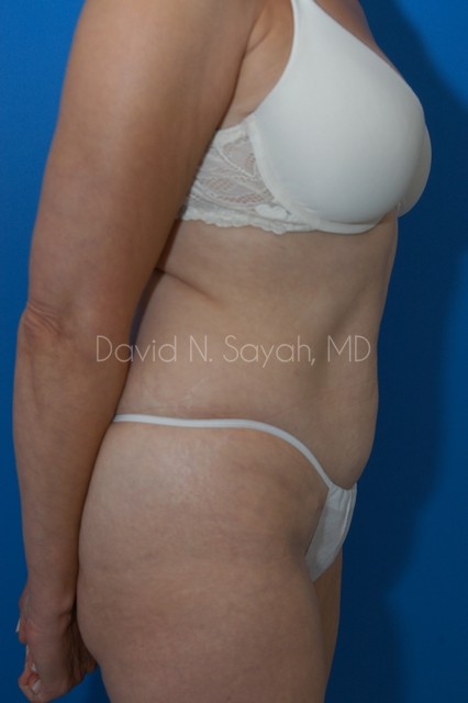 Mini Tummy Tuck Before and After | Sayah Institute