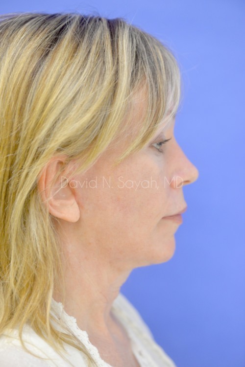 Neck Lift Before and After | Sayah Institute