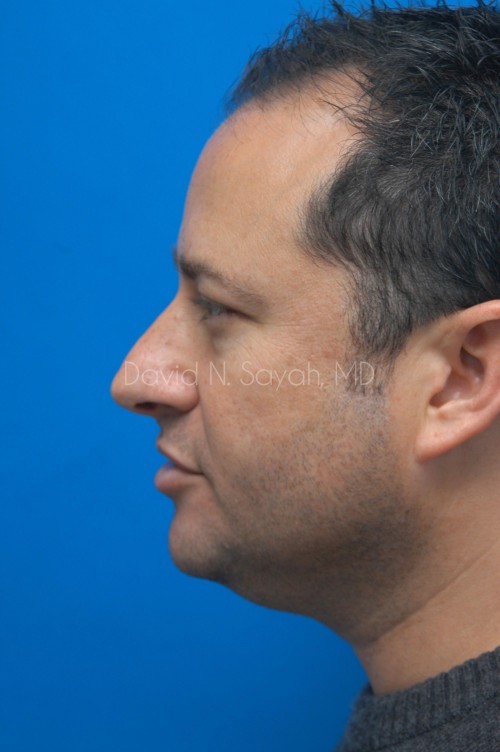 Neck Lift Before and After | Sayah Institute