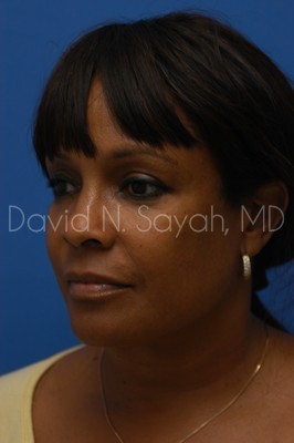 Neck Lift Before and After | Sayah Institute