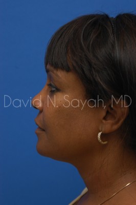 Neck Lift Before and After | Sayah Institute