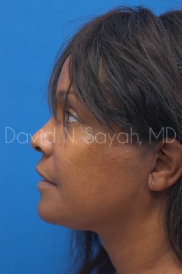 Neck Lift Before and After | Sayah Institute