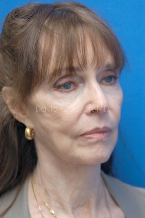 Neck Lift Before and After | Sayah Institute