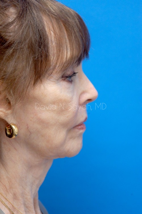 Neck Lift Before and After | Sayah Institute