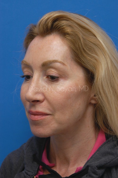 Neck Lift Before and After | Sayah Institute