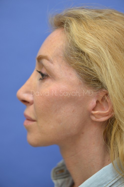 Neck Lift Before and After | Sayah Institute