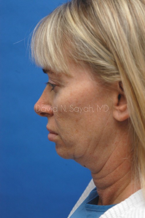 Neck Lift Before and After | Sayah Institute
