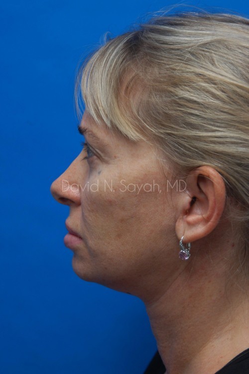 Neck Lift Before and After | Sayah Institute