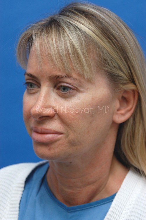 Neck Lift Before and After | Sayah Institute