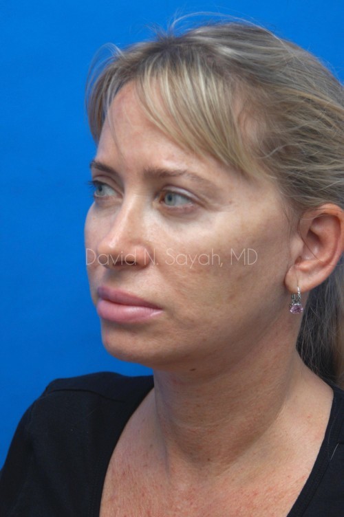 Neck Lift Before and After | Sayah Institute