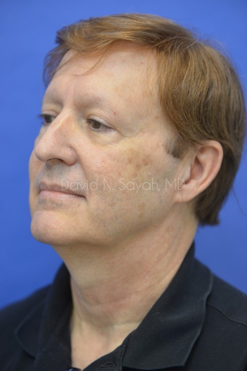 Neck Lift Before and After | Sayah Institute