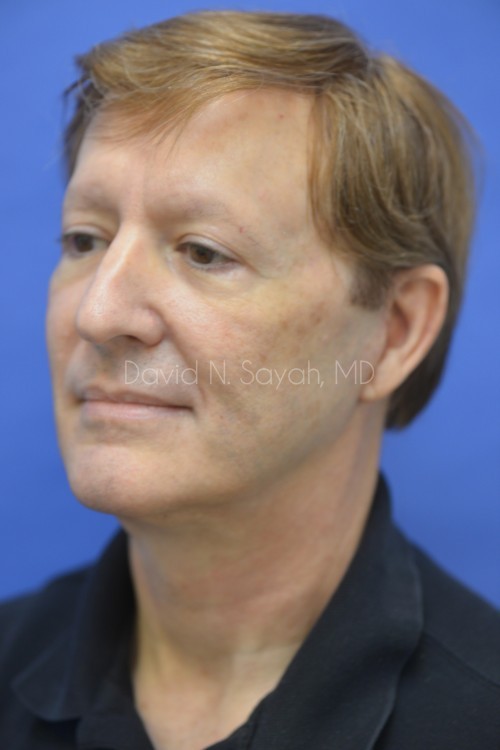 Neck Lift Before and After | Sayah Institute