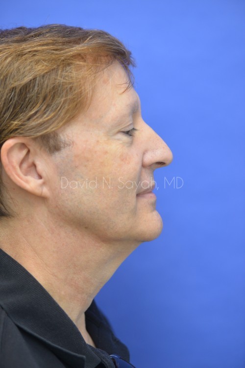 Neck Lift Before and After | Sayah Institute