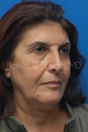 Neck Lift Before and After | Sayah Institute
