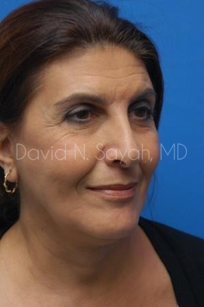 Neck Lift Before and After | Sayah Institute