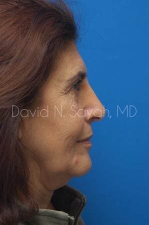 Neck Lift Before and After | Sayah Institute