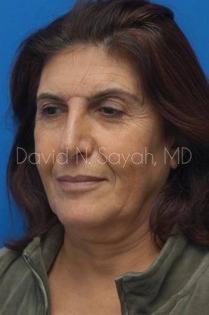 Neck Lift Before and After | Sayah Institute
