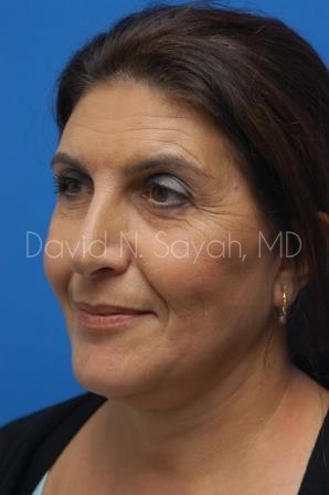 Neck Lift Before and After | Sayah Institute