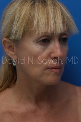 Neck Lift Before and After | Sayah Institute