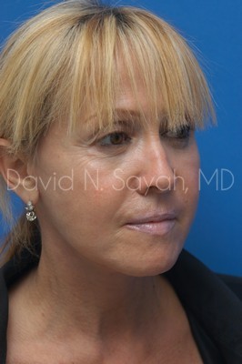 Neck Lift Before and After | Sayah Institute