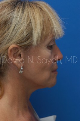 Neck Lift Before and After | Sayah Institute