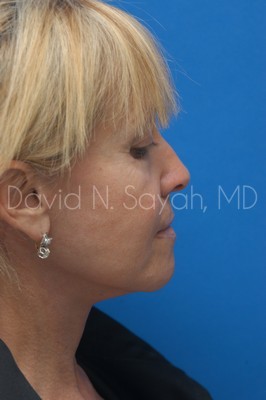 Neck Lift Before and After | Sayah Institute