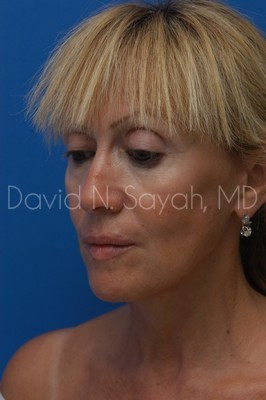 Neck Lift Before and After | Sayah Institute
