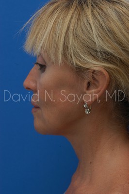 Neck Lift Before and After | Sayah Institute