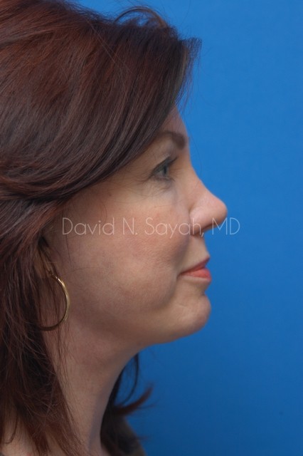 Neck Lift Before and After | Sayah Institute