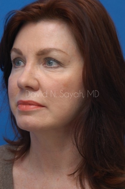 Neck Lift Before and After | Sayah Institute