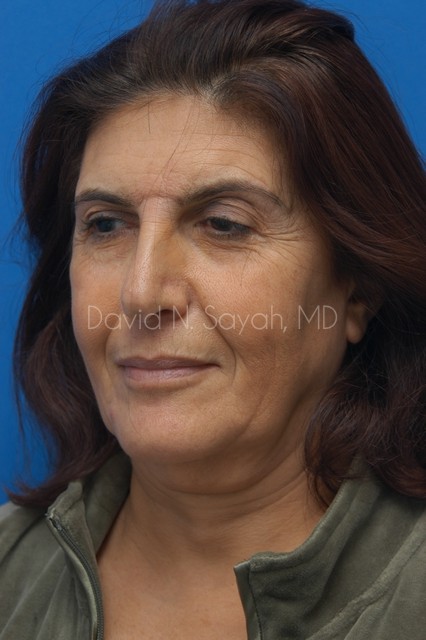 Neck Lift Before and After | Sayah Institute