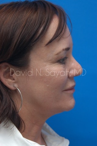 Neck Lift Before and After | Sayah Institute