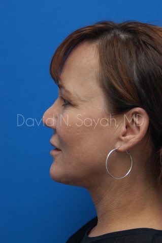 Neck Lift Before and After | Sayah Institute