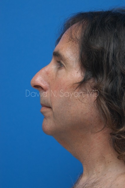 Neck Lift Before and After | Sayah Institute