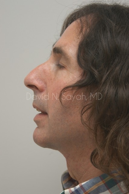 Neck Lift Before and After | Sayah Institute