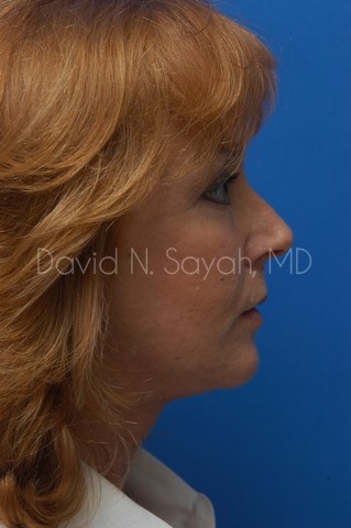 Neck Lift Before and After | Sayah Institute