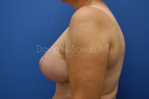 Nipple Revision Before and After | Sayah Institute