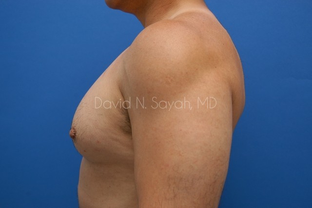 Nipple Revision Before and After | Sayah Institute