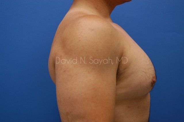 Nipple Revision Before and After | Sayah Institute