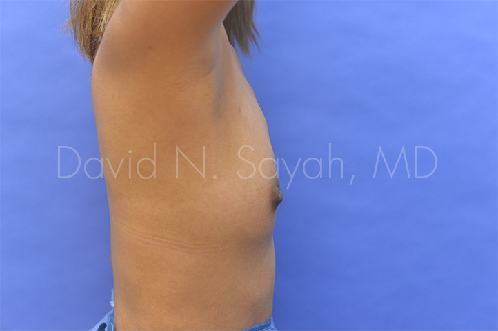 Nipple Revision Before and After | Sayah Institute