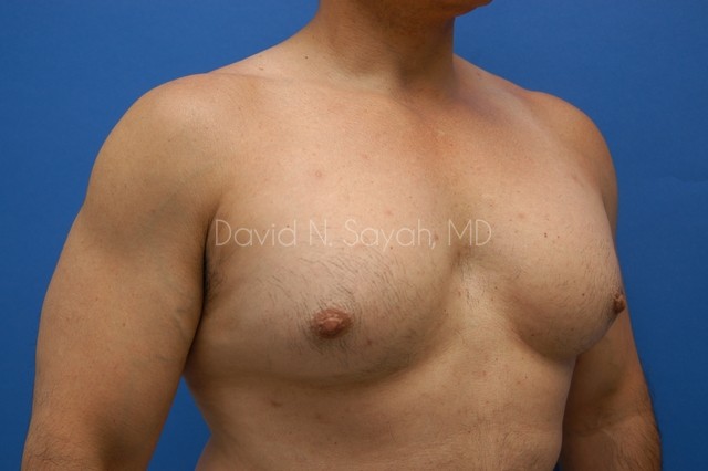 Nipple Revision Before and After | Sayah Institute