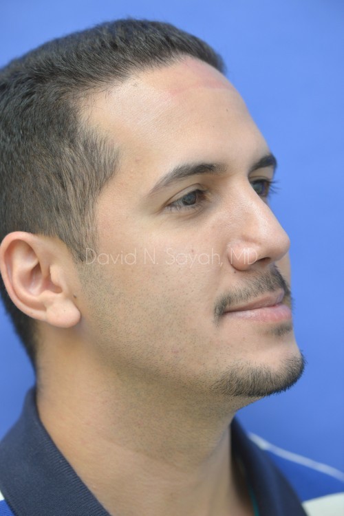 Rhinoplasty Before and After | Sayah Institute