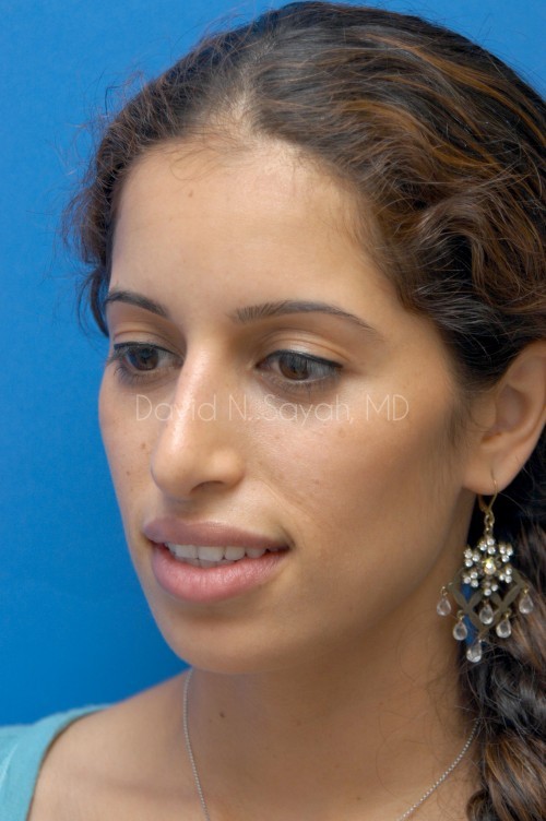 Rhinoplasty Before and After | Sayah Institute