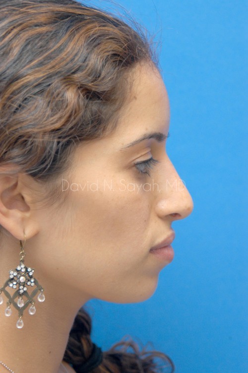 Rhinoplasty Before and After | Sayah Institute