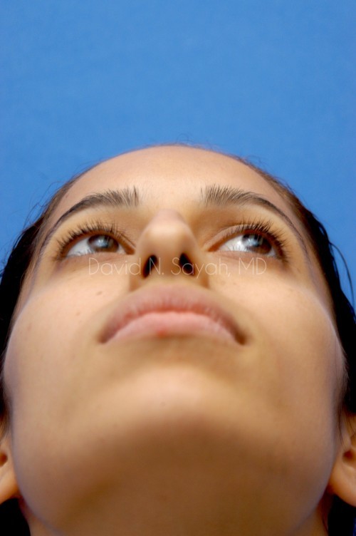 Rhinoplasty Before and After | Sayah Institute