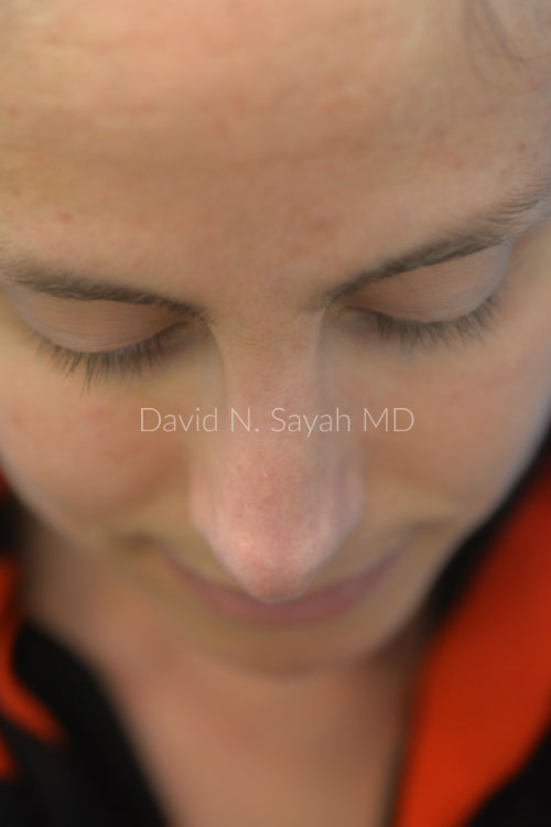 Rhinoplasty Before and After | Sayah Institute